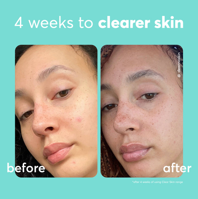 Serum për fytyrë Super Facialist Clear Skin Breakout buster, 30 ml