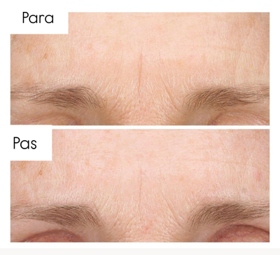 Serum për fytyrë kundër rrudhave The Ordinary Retinol 0.2% in Squalane, 30ml