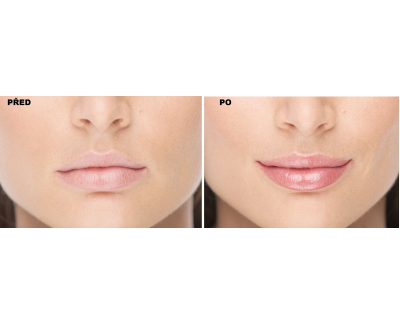 Shkëlqyes për buzë FacEvolution LipPlus Booster 5 ml