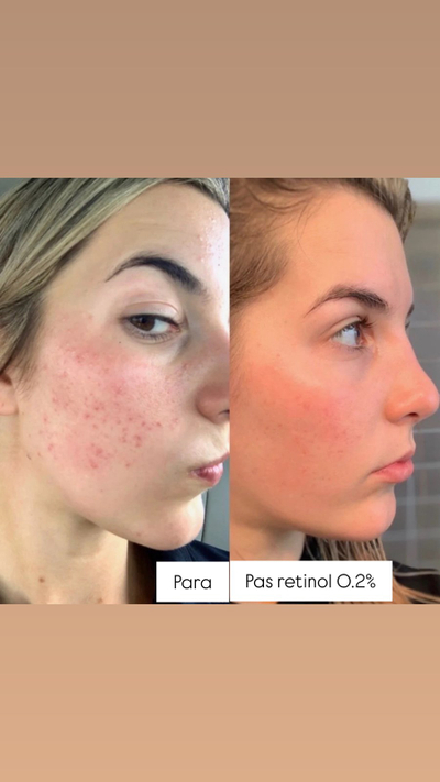 Serum për fytyrë kundër rrudhave The Ordinary Retinol 0.5% in Squalane, 30ml