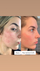 Serum për fytyrë kundër rrudhave The Ordinary Retinol 0.2% in Squalane, 30ml