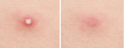 MIZON Good Bye Blemish Clear Patch, 44 Фластери